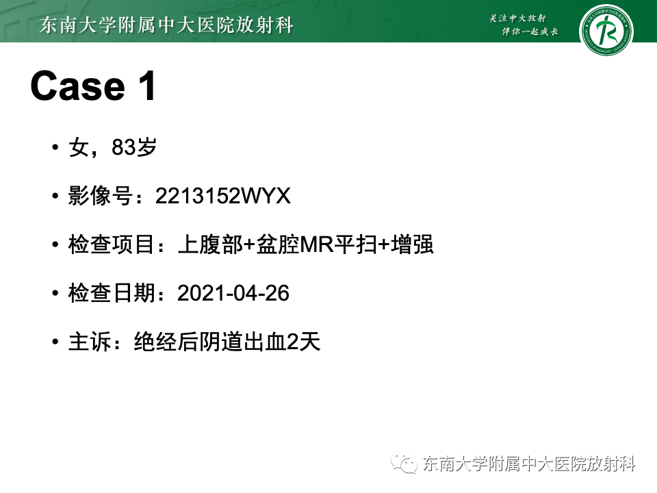 影像PPT - 【PPT】卵巢纤维上皮瘤(Brenner瘤)-1 影像PPT - 【PPT】卵巢纤维上皮瘤(Brenner瘤)-1