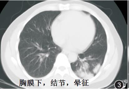影像PPT - 轻松分辨让人头痛的肺部隐球菌感染CT表现-2 影像PPT - 轻松分辨让人头痛的肺部隐球菌感染CT表现-2