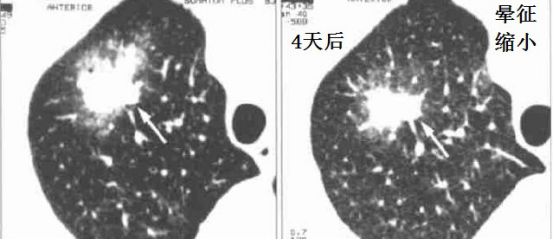 影像PPT - 轻松分辨让人头痛的肺部隐球菌感染CT表现-3 影像PPT - 轻松分辨让人头痛的肺部隐球菌感染CT表现-3