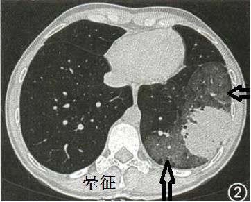 影像PPT - 轻松分辨让人头痛的肺部隐球菌感染CT表现-4 影像PPT - 轻松分辨让人头痛的肺部隐球菌感染CT表现-4