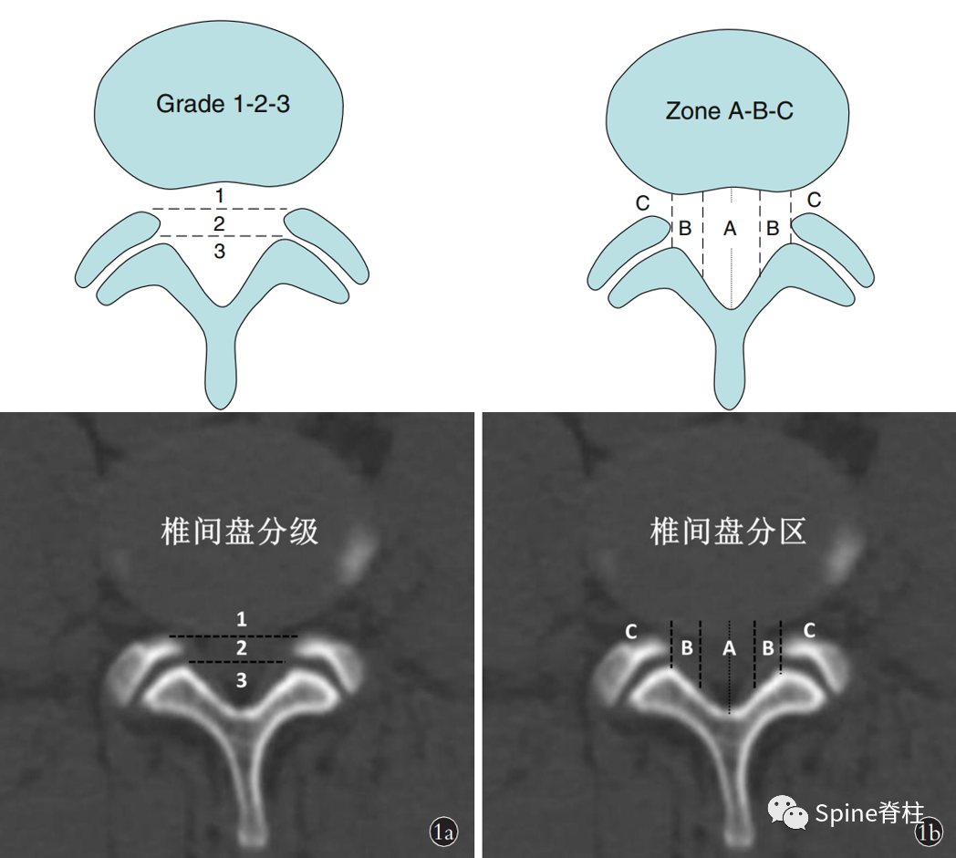 影像PPT - 腰椎间盘突出MSU分级分区-1 影像PPT - 腰椎间盘突出MSU分级分区-1