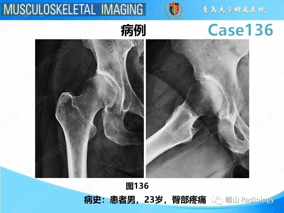 影像PPT - 【PPT】发育性髋关节发育不良-2