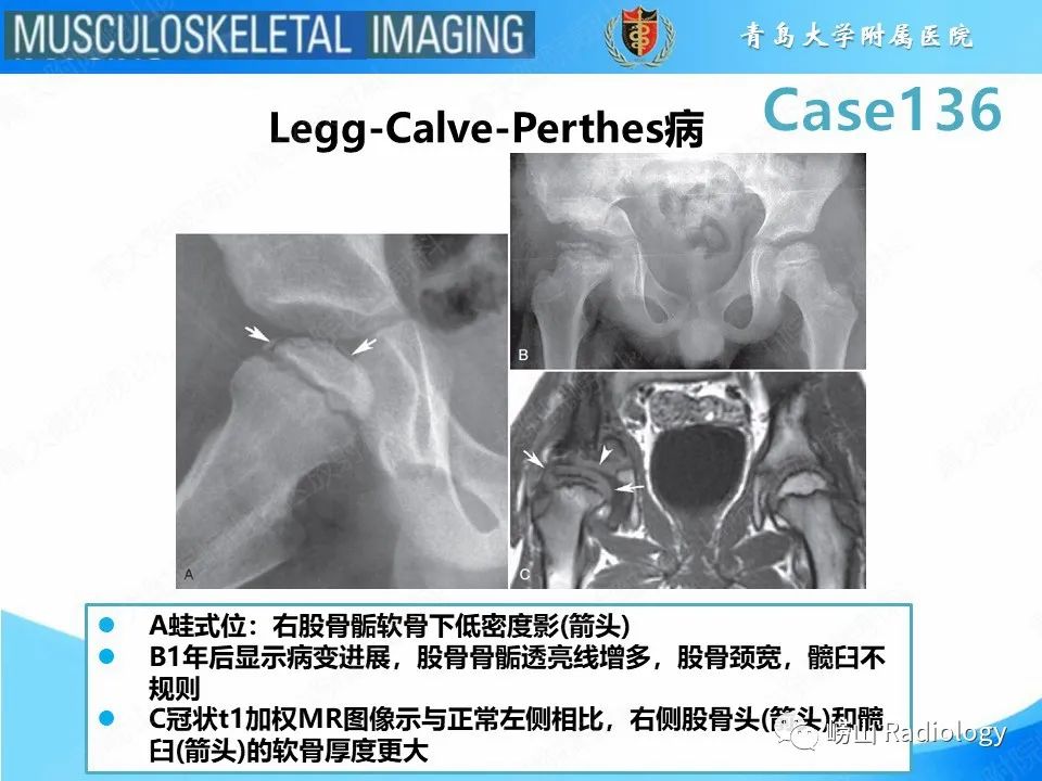 影像PPT - 【PPT】发育性髋关节发育不良-6