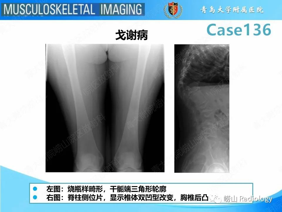 影像PPT - 【PPT】发育性髋关节发育不良-10