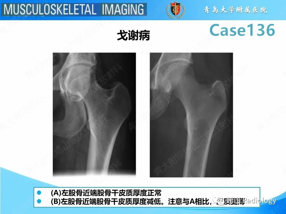 影像PPT - 【PPT】发育性髋关节发育不良-9