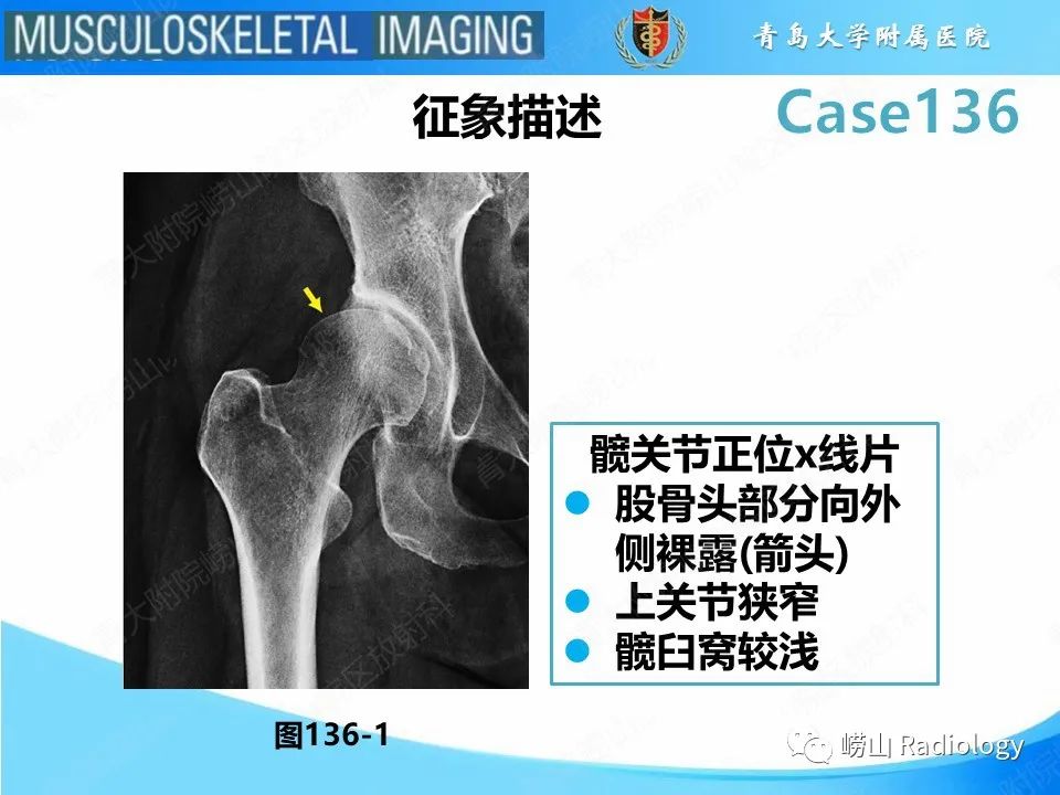 影像PPT - 【PPT】发育性髋关节发育不良-12