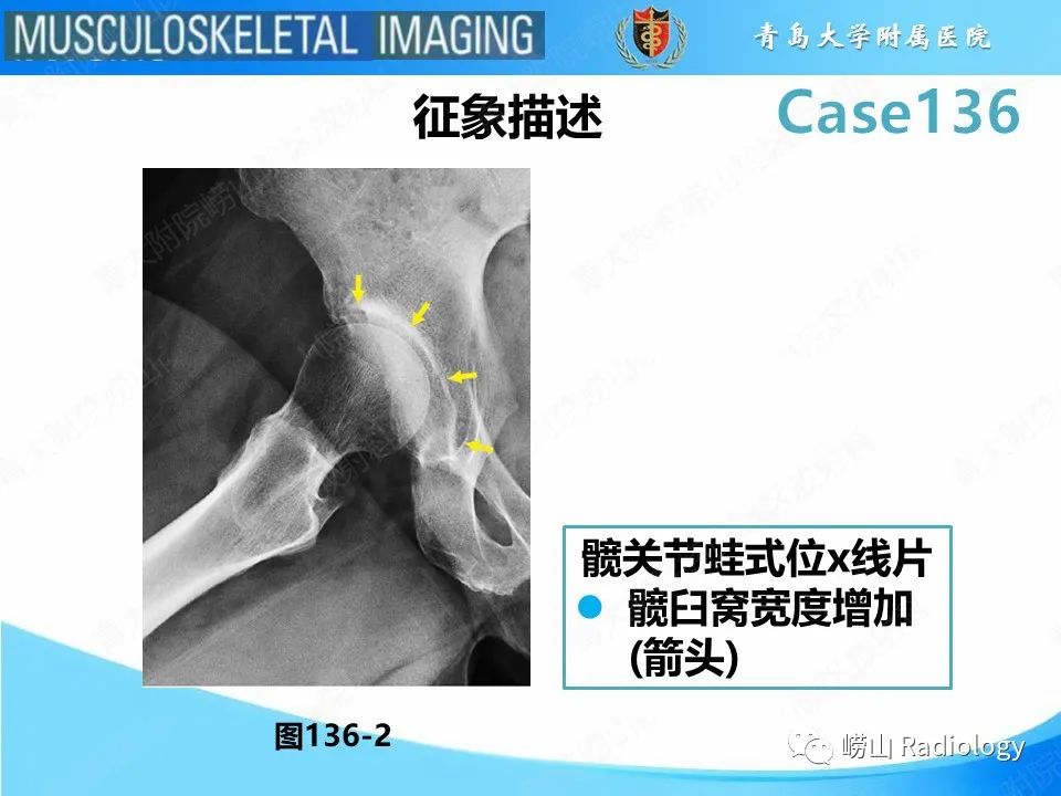 影像PPT - 【PPT】发育性髋关节发育不良-13