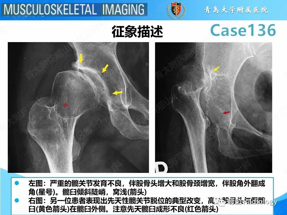 影像PPT - 【PPT】发育性髋关节发育不良-14