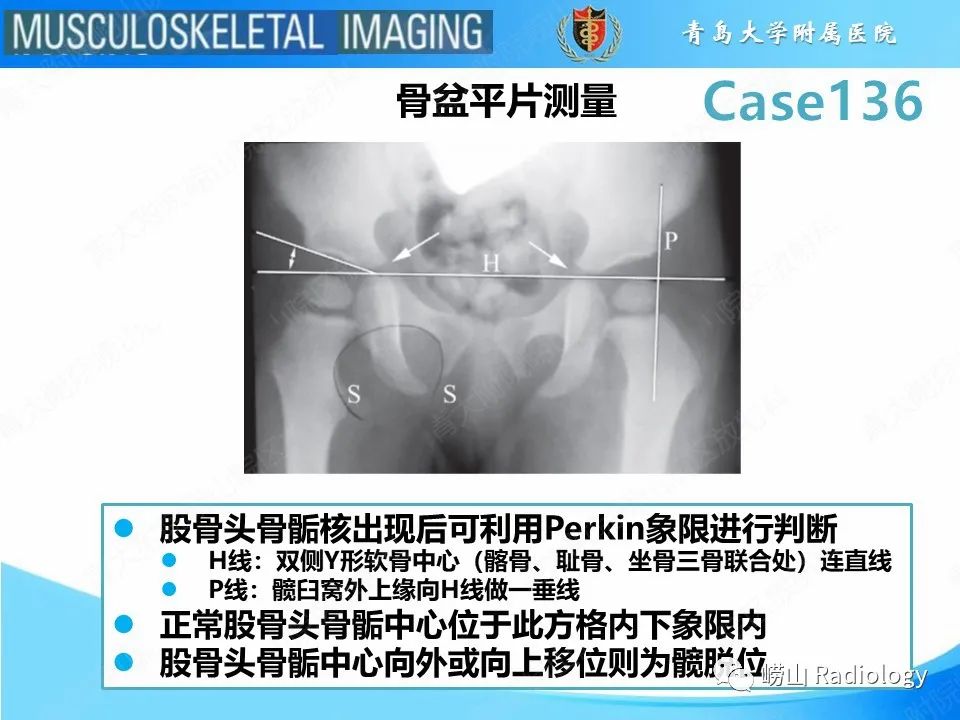 影像PPT - 【PPT】发育性髋关节发育不良-18