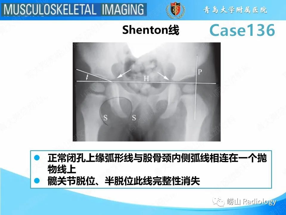 影像PPT - 【PPT】发育性髋关节发育不良-20