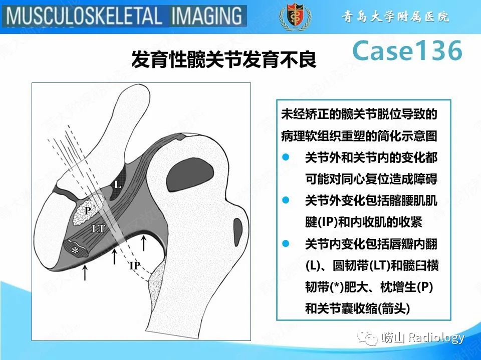 影像PPT - 【PPT】发育性髋关节发育不良-24