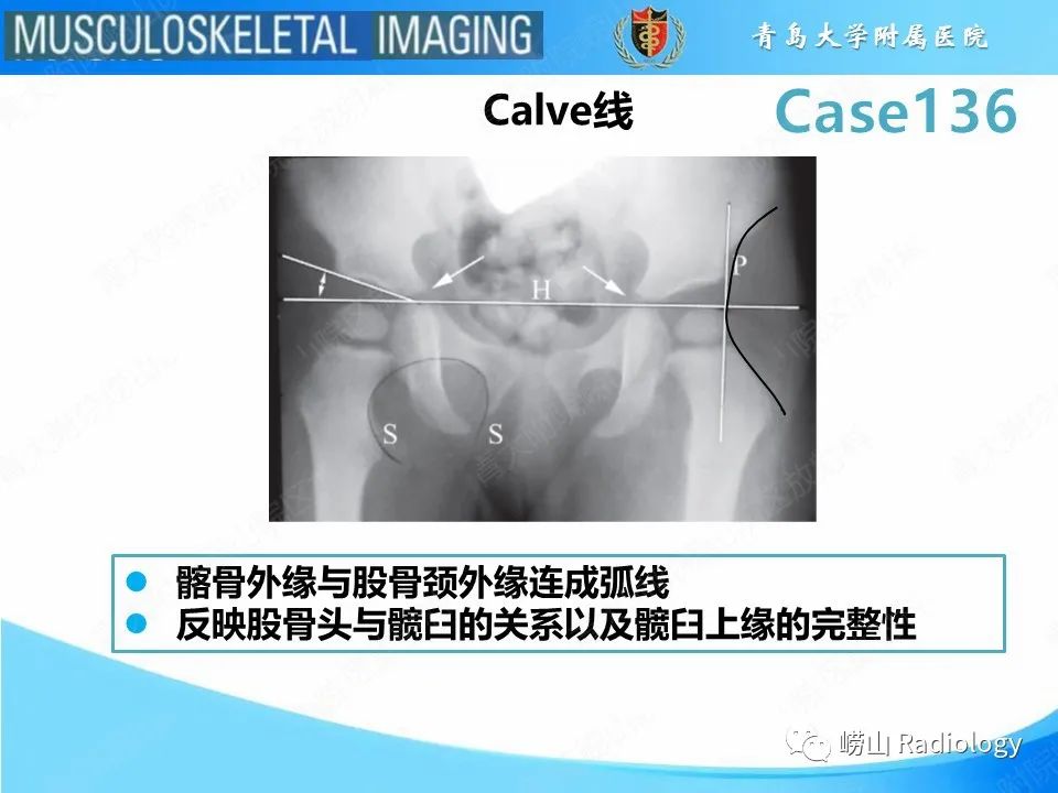 影像PPT - 【PPT】发育性髋关节发育不良-21