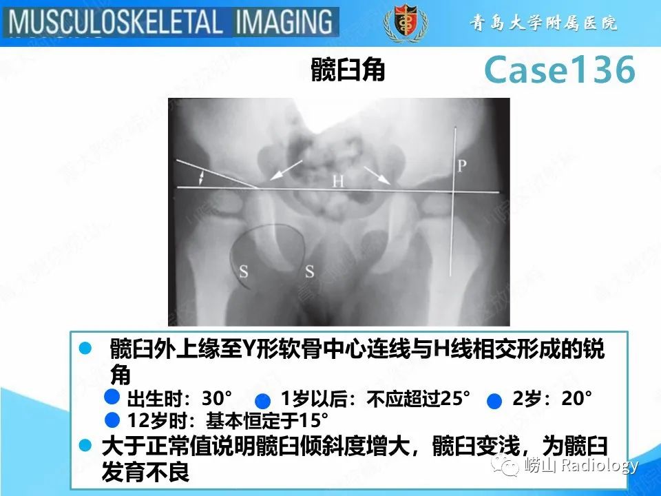 影像PPT - 【PPT】发育性髋关节发育不良-19