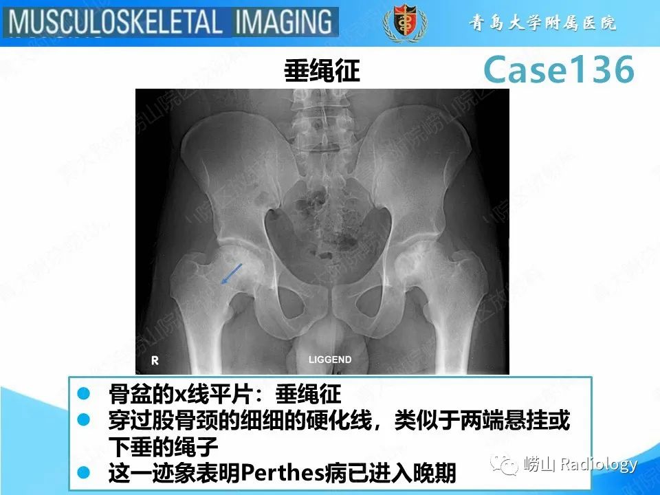 影像PPT - 【PPT】发育性髋关节发育不良-27