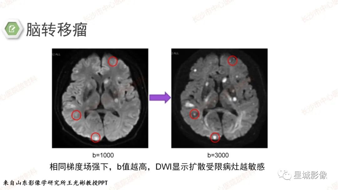 影像PPT - 【PPT】DWI序列判读原则及临床应用-14