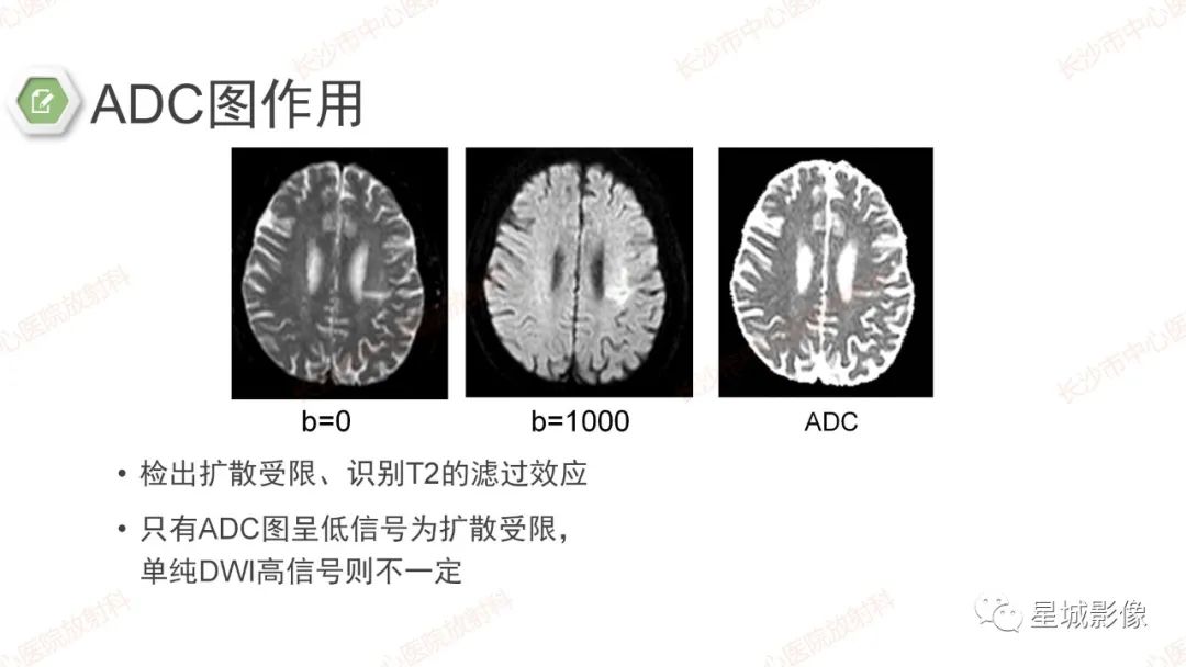 影像PPT - 【PPT】DWI序列判读原则及临床应用-21