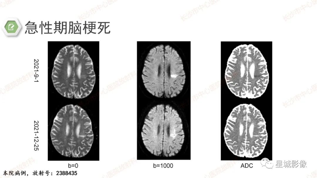 影像PPT - 【PPT】DWI序列判读原则及临床应用-25