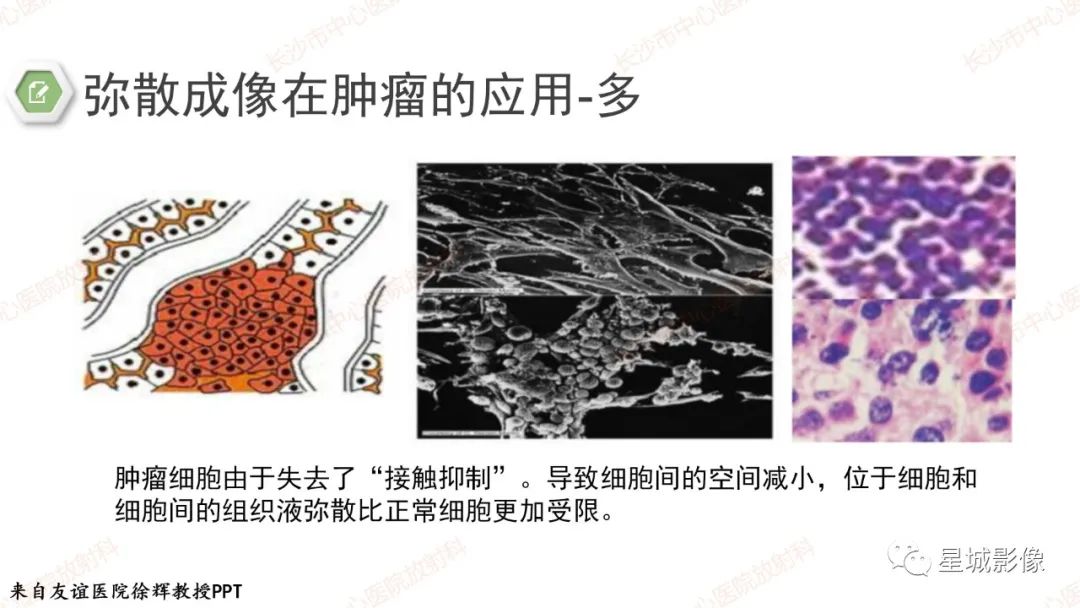 影像PPT - 【PPT】DWI序列判读原则及临床应用-26