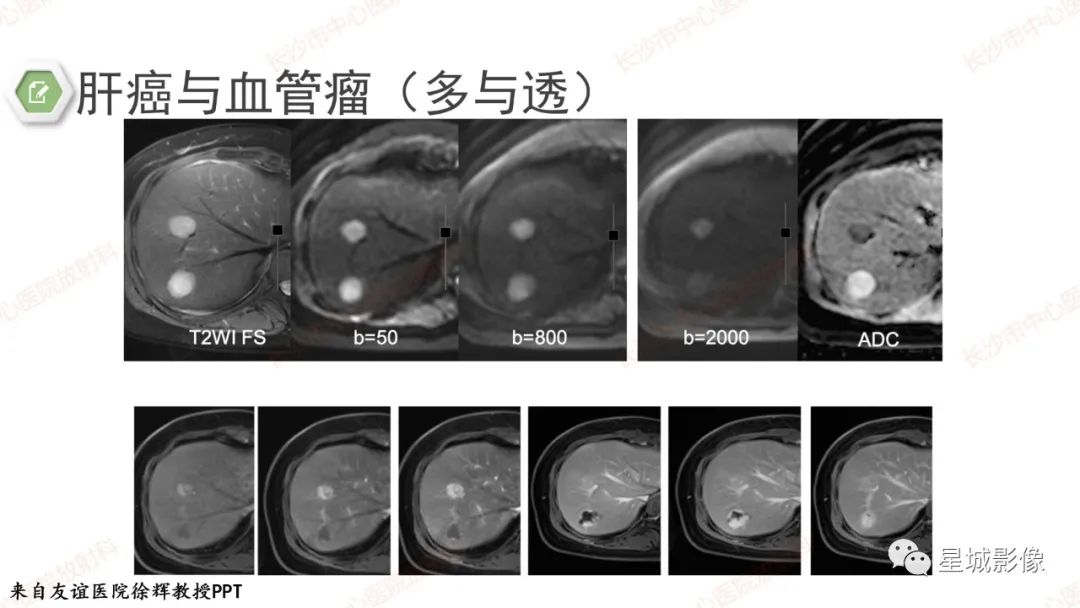 影像PPT - 【PPT】DWI序列判读原则及临床应用-28