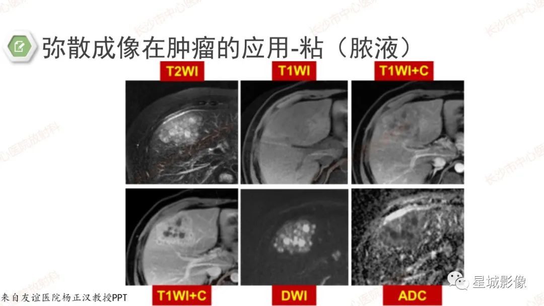 影像PPT - 【PPT】DWI序列判读原则及临床应用-31