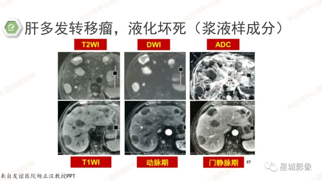 影像PPT - 【PPT】DWI序列判读原则及临床应用-32