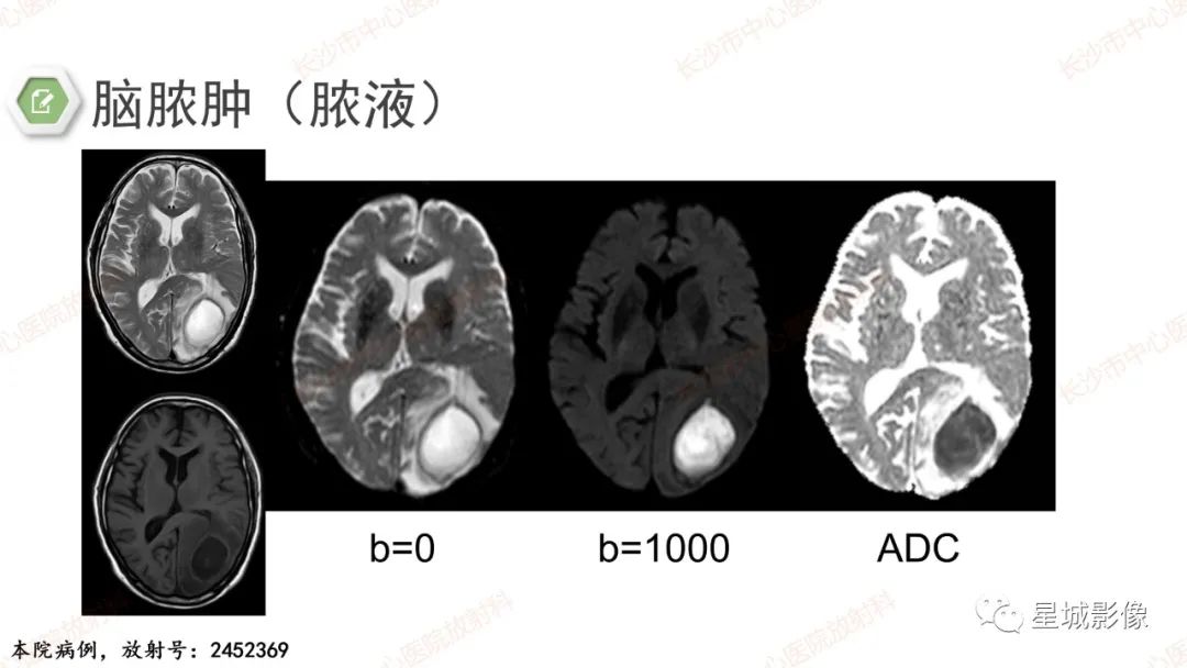 影像PPT - 【PPT】DWI序列判读原则及临床应用-33