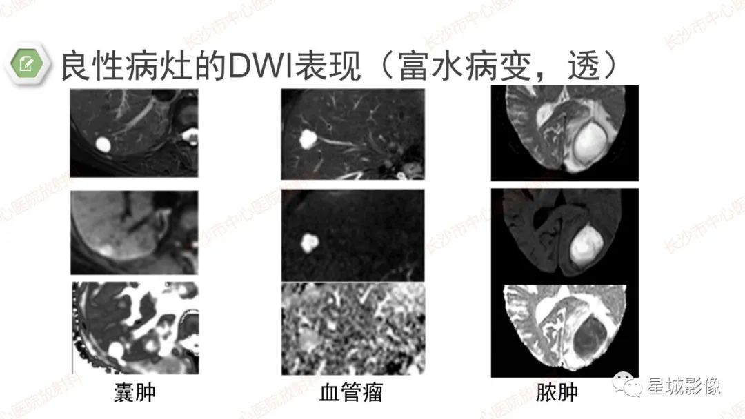 影像PPT - 【PPT】DWI序列判读原则及临床应用-35