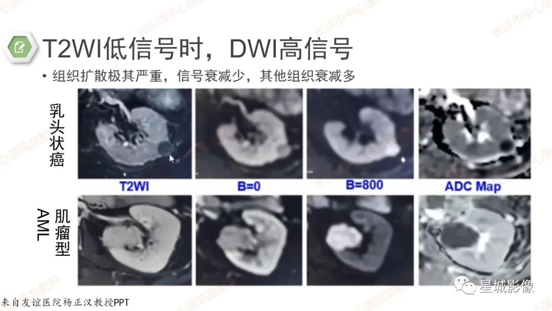 影像PPT - 【PPT】DWI序列判读原则及临床应用-37