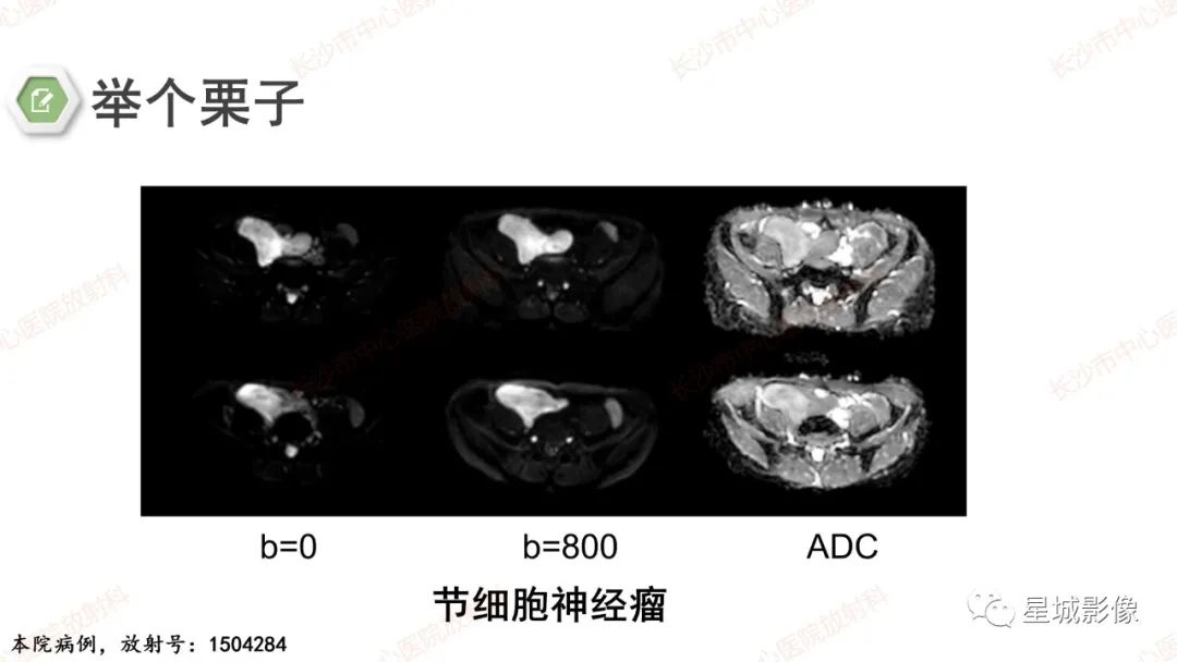 影像PPT - 【PPT】DWI序列判读原则及临床应用-41
