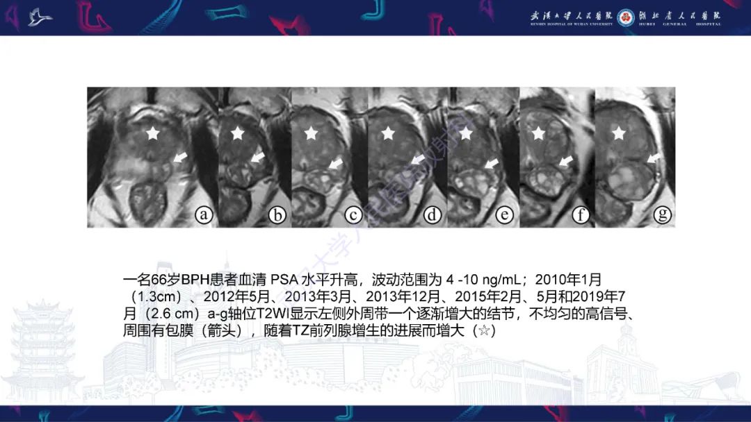 影像PPT - 【PPT】前列腺少见病变MRI诊断-16