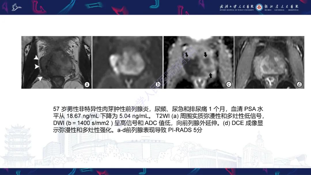 影像PPT - 【PPT】前列腺少见病变MRI诊断-22