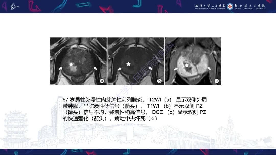 影像PPT - 【PPT】前列腺少见病变MRI诊断-24