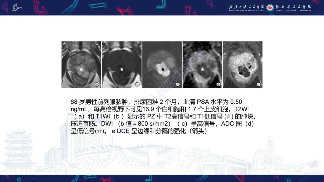 影像PPT - 【PPT】前列腺少见病变MRI诊断-27