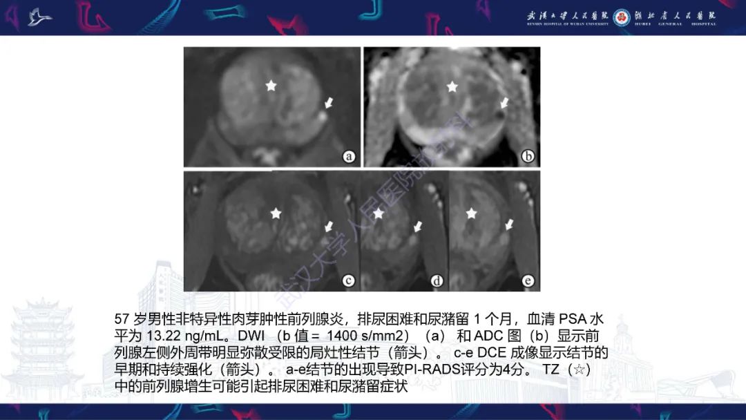 影像PPT - 【PPT】前列腺少见病变MRI诊断-23