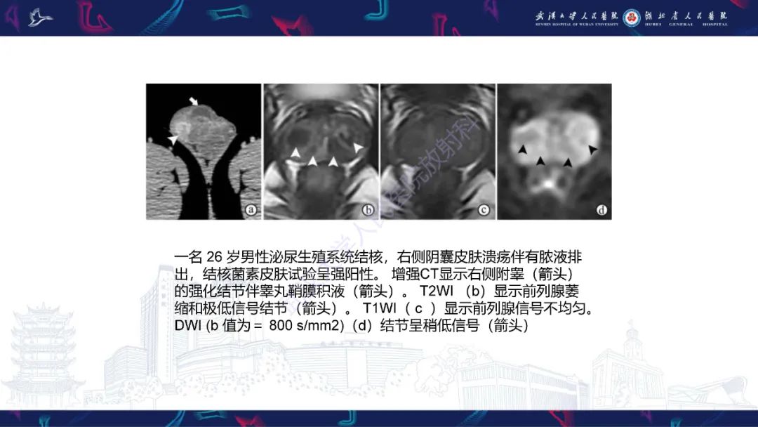 影像PPT - 【PPT】前列腺少见病变MRI诊断-31