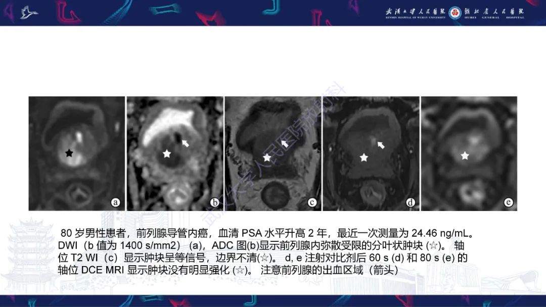 影像PPT - 【PPT】前列腺少见病变MRI诊断-36