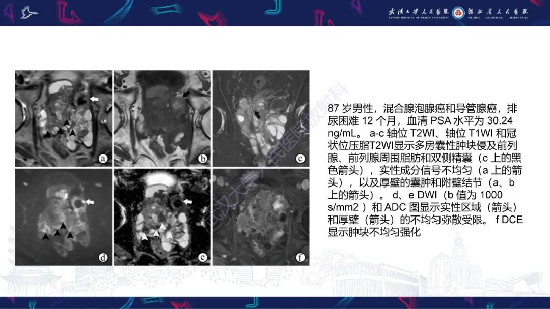 影像PPT - 【PPT】前列腺少见病变MRI诊断-39