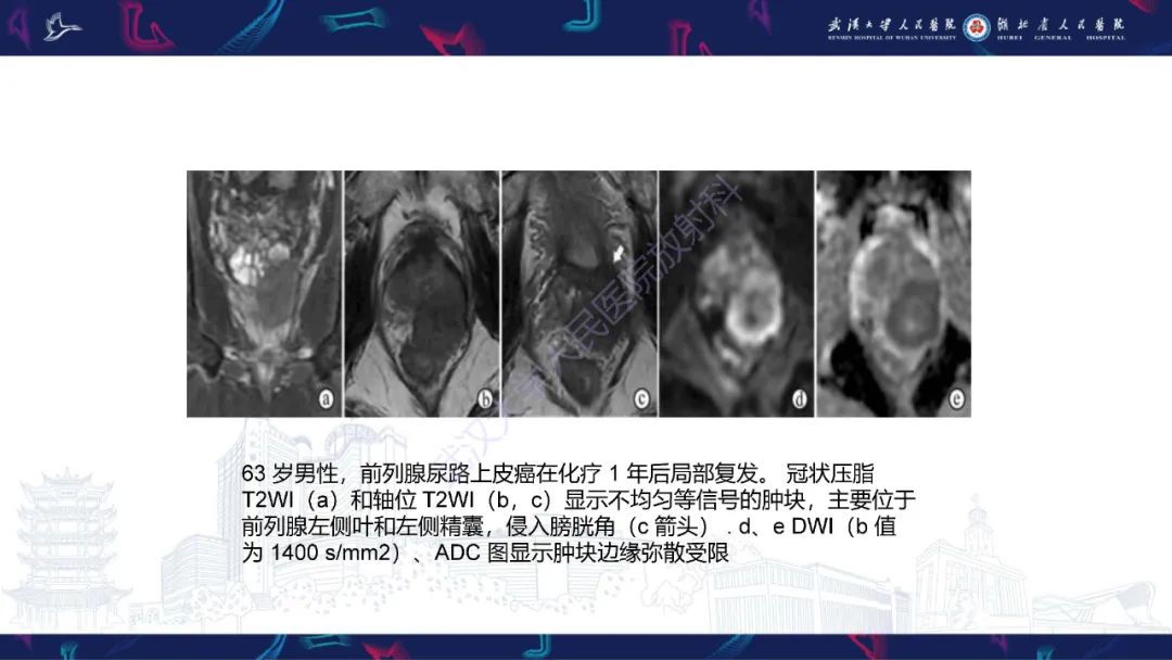 影像PPT - 【PPT】前列腺少见病变MRI诊断-42