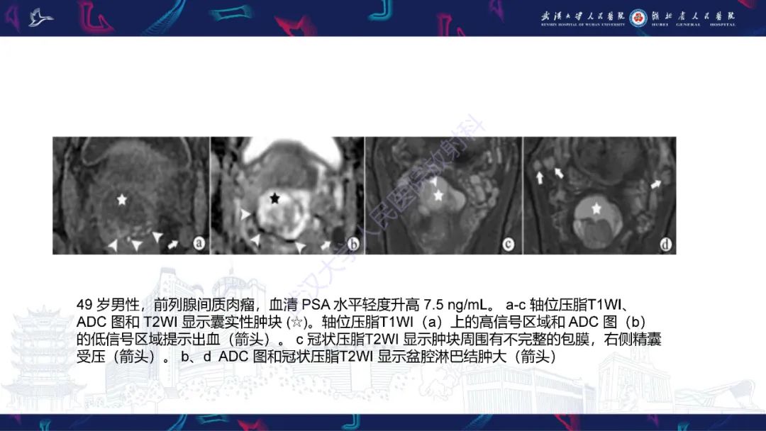 影像PPT - 【PPT】前列腺少见病变MRI诊断-46