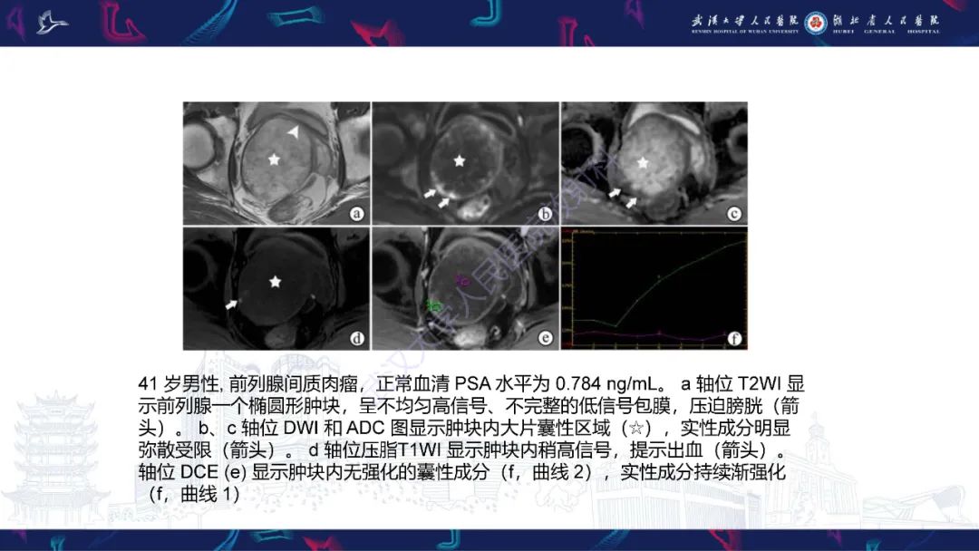 影像PPT - 【PPT】前列腺少见病变MRI诊断-47