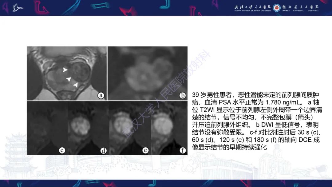 影像PPT - 【PPT】前列腺少见病变MRI诊断-48