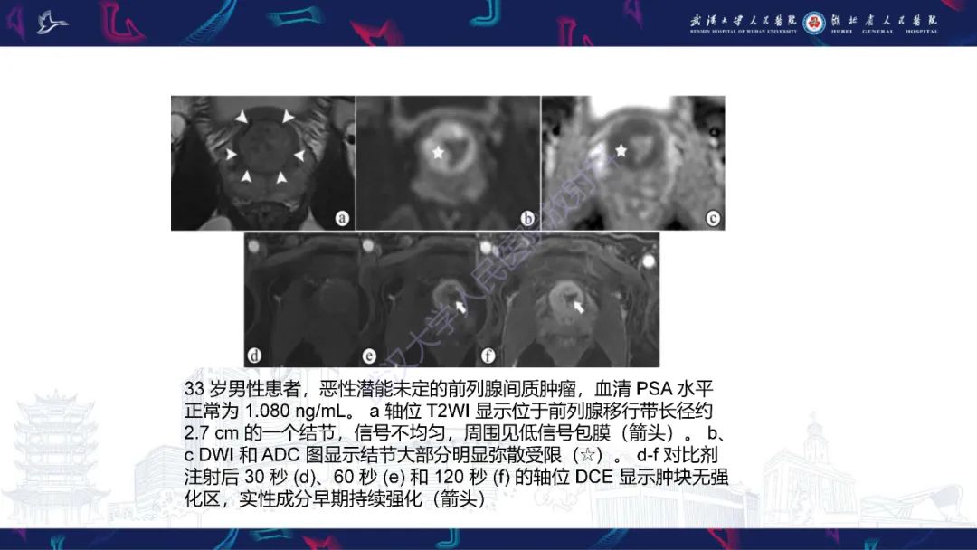 影像PPT - 【PPT】前列腺少见病变MRI诊断-49