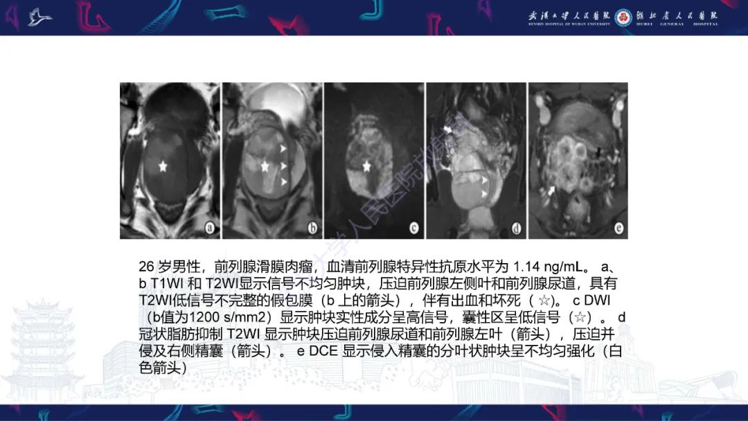 影像PPT - 【PPT】前列腺少见病变MRI诊断-54