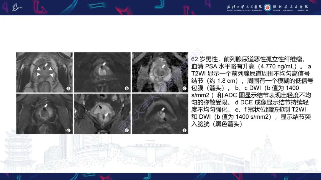 影像PPT - 【PPT】前列腺少见病变MRI诊断-57