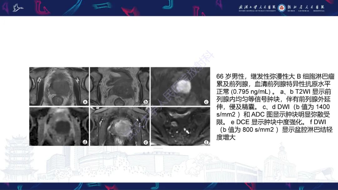 影像PPT - 【PPT】前列腺少见病变MRI诊断-60