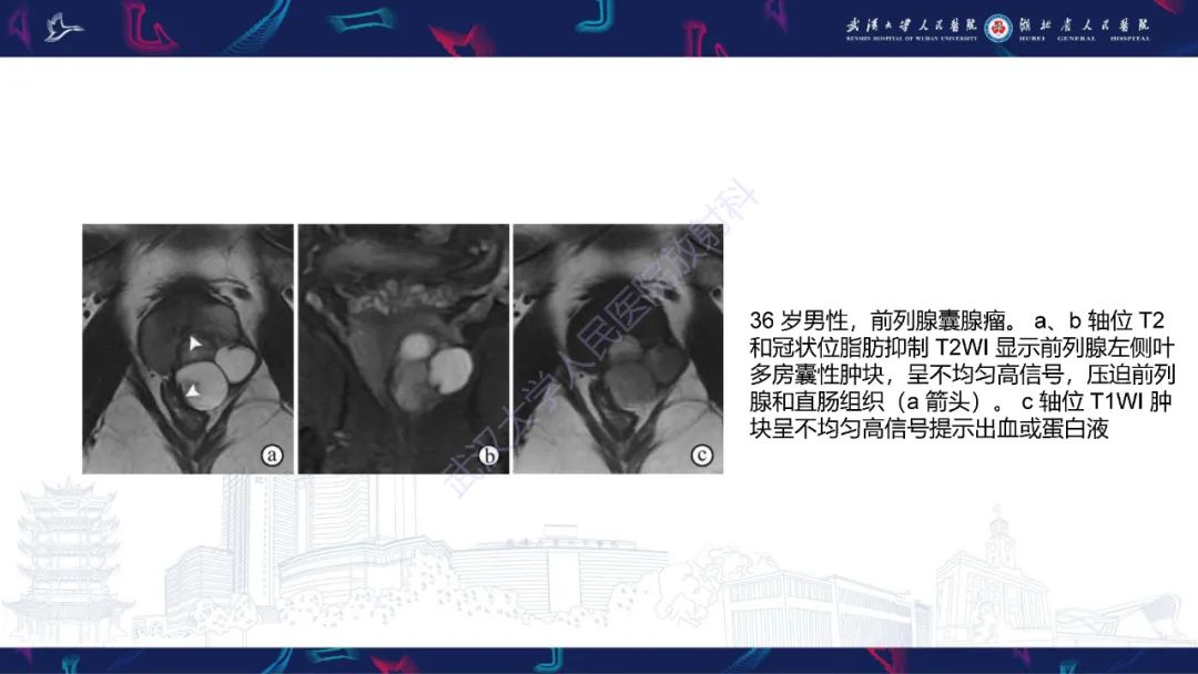 影像PPT - 【PPT】前列腺少见病变MRI诊断-63