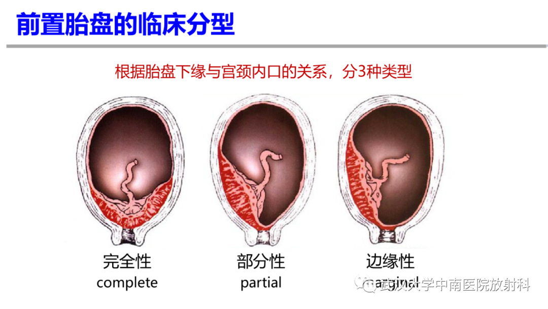 影像PPT - 【PPT】前置胎盘及胎盘植入磁共振成像-11
