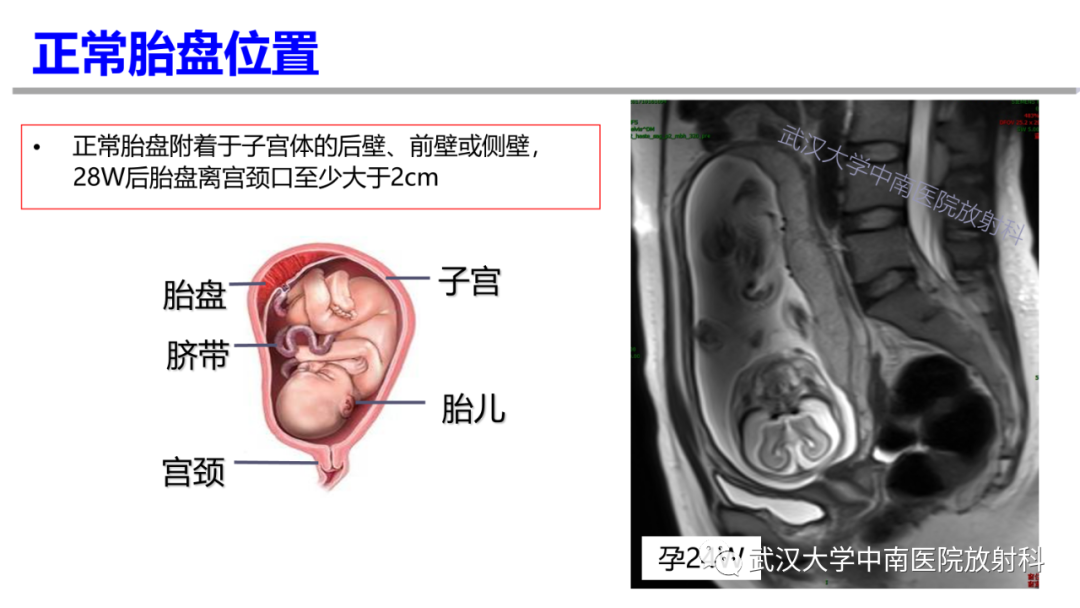 影像PPT - 【PPT】前置胎盘及胎盘植入磁共振成像-9