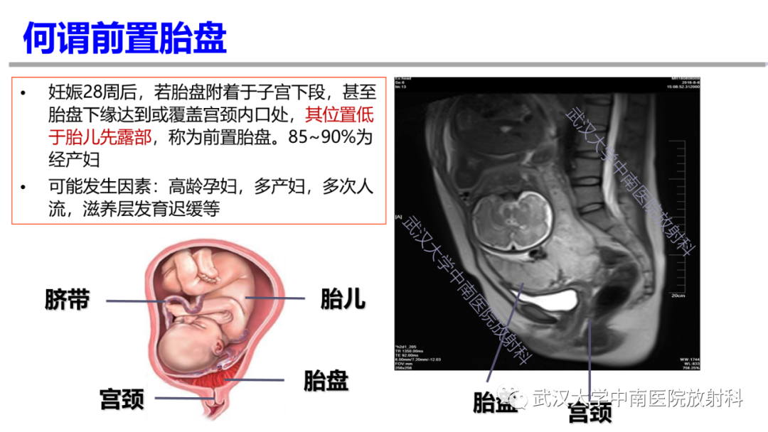 影像PPT - 【PPT】前置胎盘及胎盘植入磁共振成像-10