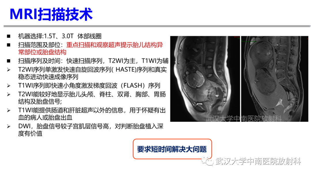 影像PPT - 【PPT】前置胎盘及胎盘植入磁共振成像-7